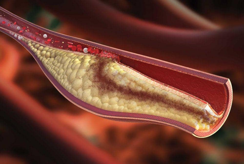 Hiperlipidemia: Penyebab, Gejala, dan Pengobatan | IDN Times