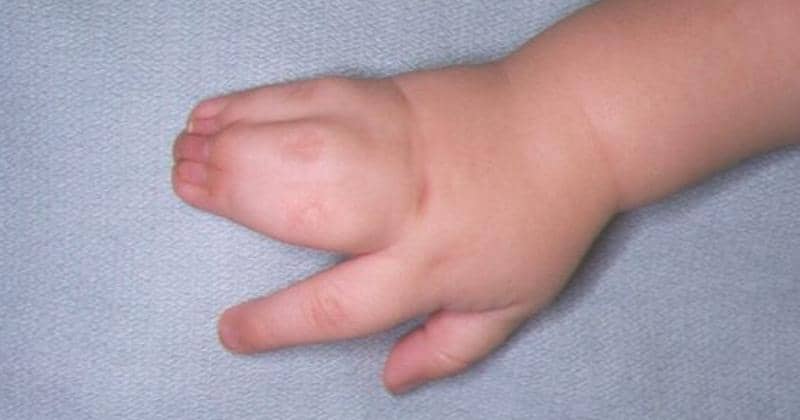 Sindaktili pada Bayi: Gejala, Penyebab, dan Pengobatannya | Popmama.com