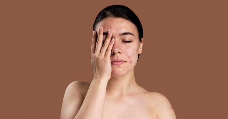 Cara Mengatasi Kulit Meradang Akibat Salah Pakai Skincare