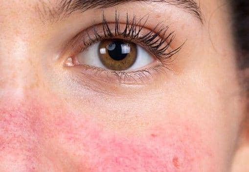 ilustrasi kulit wajah merah (flickr.com/London Dermatology Clinic)