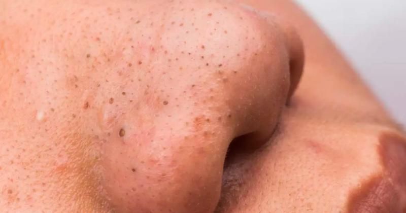 7 Cara Mengatasi Komedo agar Tak Muncul Lagi