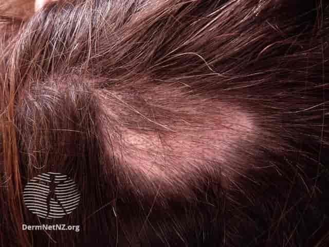ilustrasi alopecia areata (sml.snl.no)