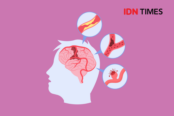 Perbedaan Stroke Iskemik dan Hemoragik, Mana yang Lebih Bahaya?
