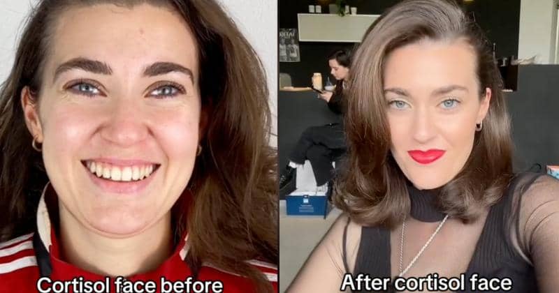 Mengenal Cortisol Face, Perubahan pada Wajah Akibat Stres | Popmama.com