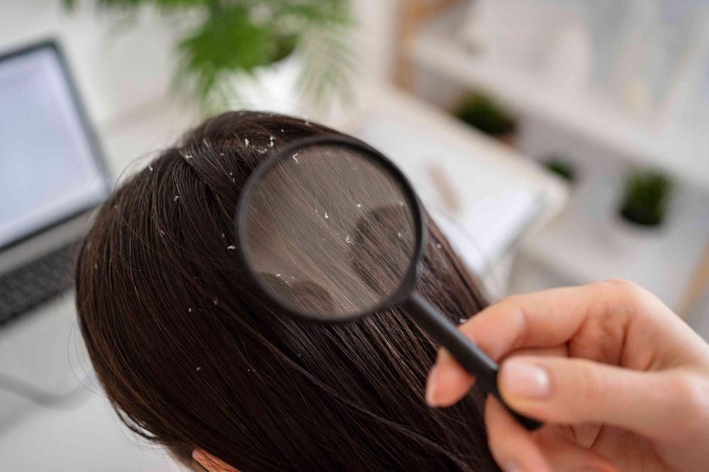 6 Shampo Anti Ketombe Terbaik 2025, Ampuh Bikin Rambut Sehat