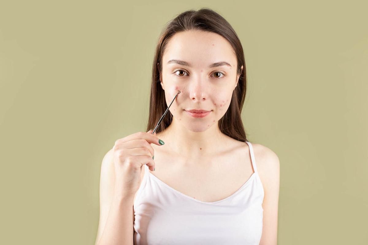 5 Rekomendasi Obat Totol Jerawat untuk Kulit Sensitif, Dijamin Ampuh!