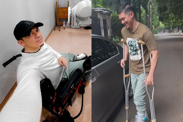 Irwansyah Alami Patah Tulang Kaki, Jalan Pakai Tongkat