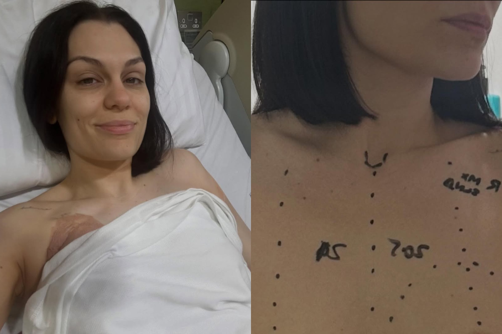 Perjalanan Jessie J Melawan Kanker Payudara Stadium Awal