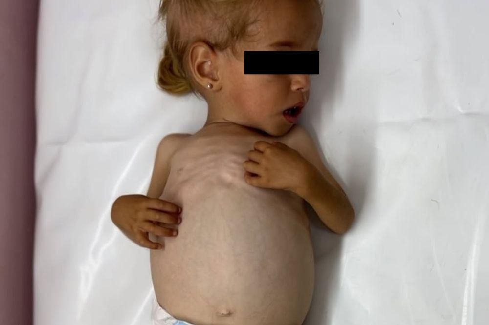 Tragis! 66 Anak Gaza Meninggal karena Gizi Buruk Akibat Blokade Israel