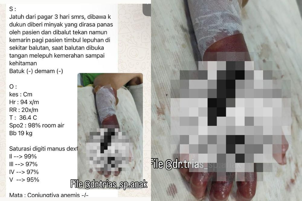 Jangan Buru-Buru Dipijat! Begini Penanganan Tepat saat Anak Jatuh