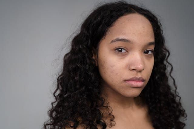 Ilustrasi bekas jerawat